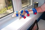HandAtrophy_0243.JPG