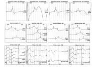 Upper Extremity EMG 4.png