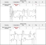 EMG6.jpg