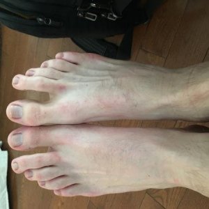 Foot atrophy