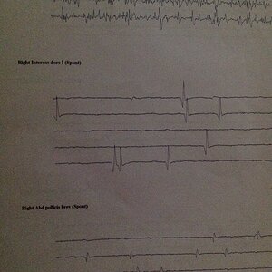 Media 'image.jpeg' in category 'Could this be ALS?'